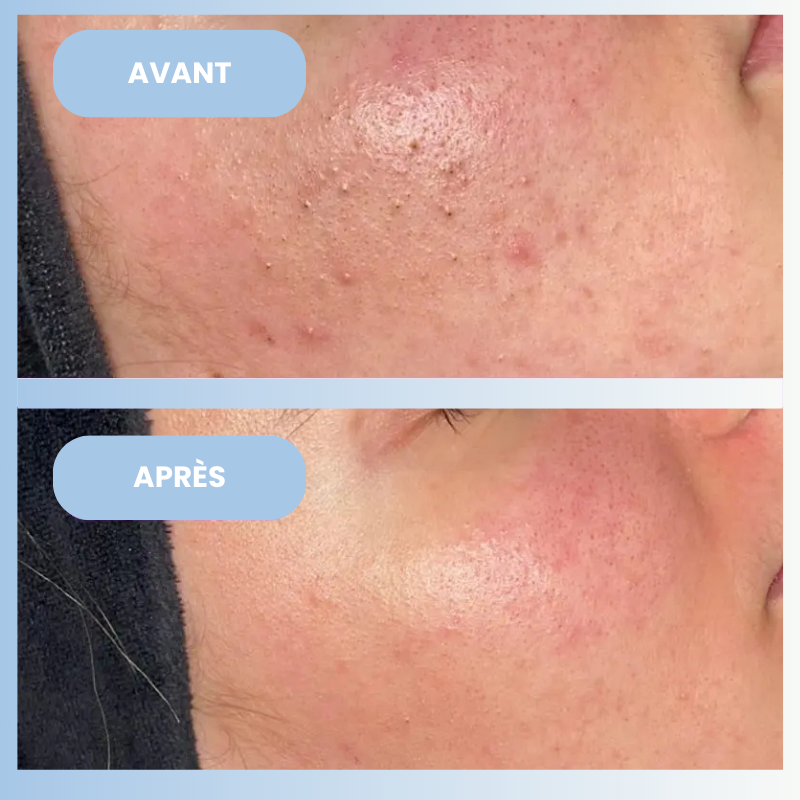 HydroPure by Skinova - Le Nettoyeur Visage à Hydrodermabrasion