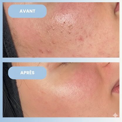 HydroPure™ - Aspirateur Points Noirs & Hydrodermabrasion Professionnel